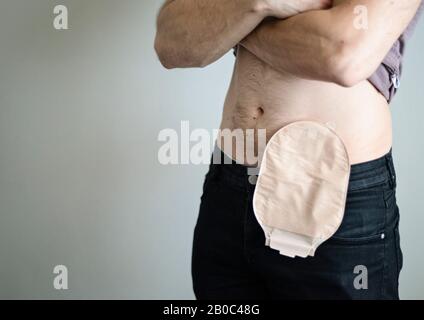 Front View On Colostomy Bag Needed After Colostomy Surgery Colon