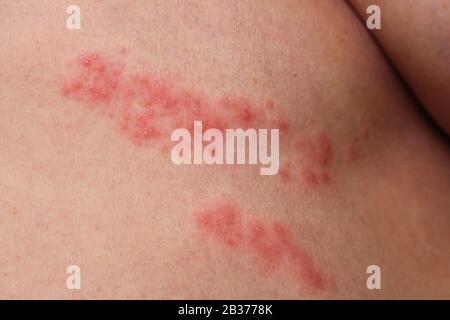 G Rtelrose Herpes Zoster Stock Photo Alamy