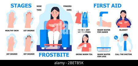 Frostbite Stages Info Graphic Vector Hypothermia In Winter Season