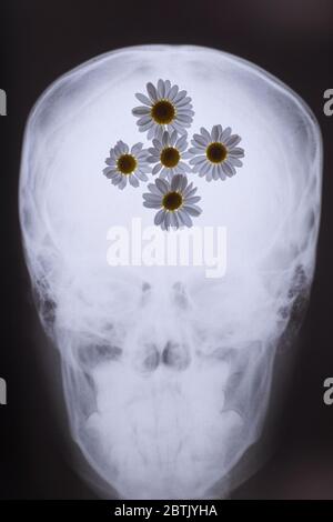 A Roentgenogram X Ray Photography Picture Of Cranium Scull Profile X