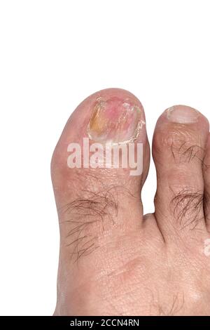 Toenail Nail Fungus Big Toe Of A Person Suffering From Onychomycosis