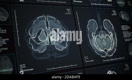 D Analysis Of A Human Brain With Mri Magnetic Resonance Imaging