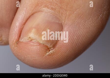 Fungus Of Nails On The Big Toe Dermatomycosis And Onychomycosis