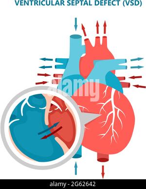 Ventricular Septal Defect Vsd Human Heart Muscle Diseases Cross