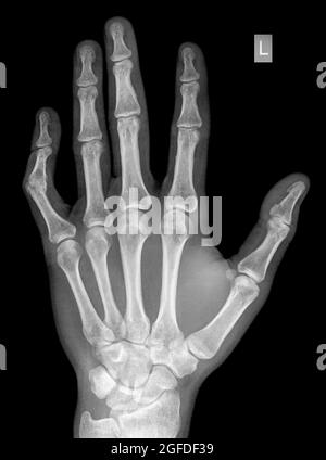 X Ray Of Wrist Of Year Old Male Patient With Distal Radius And Ulna