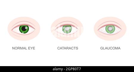 Eye Healthy And With Glaucoma Closeup View Normal And Hazy Redness