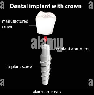 Dental Implant With Crown Stock Vector Image Art Alamy