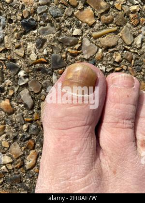 Big Toe Nail Of A Person Suffering From Onychomycosis A Fungal