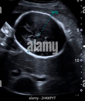 Foetal Measurement Ultrasound Scan Stock Photo Alamy