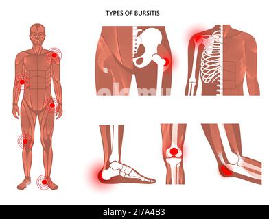 Types Of Bursitis Illustration Stock Photo Alamy