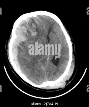 Subarachnoid Haemorrhage Ct Scan Stock Photo Alamy