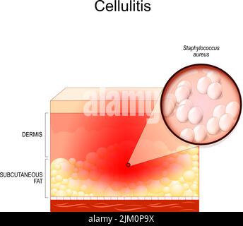 Skin With Cellulite Cross Section Of Human Skin Layers Structure