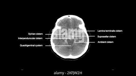 Subarachnoid Haemorrhage CT Scan Stock Photo Alamy