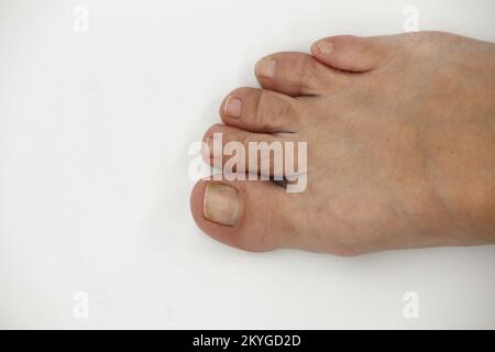 Big Toe Nail Of A Person Suffering From Onychomycosis A Fungal