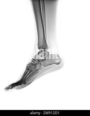 X Ray Foot And Ankle Lateral View Stock Photo Alamy