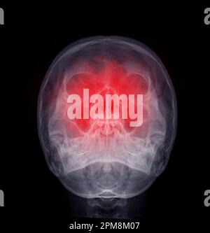 X Ray Image Of Human Skull Water S View For Diagnosis Skull Fracture