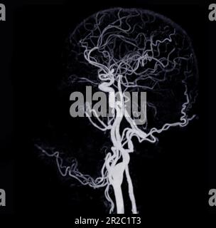 Ct Angiography Of The Brain Or Cta Brain Showing Cerebral Artery Stock