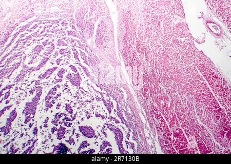 Histopathology Of Bacterial Myocarditis Inflammatory Heart Disease