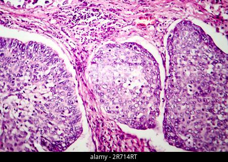 Lung Adenocarcinoma Light Micrograph Photo Under Microscope Stock