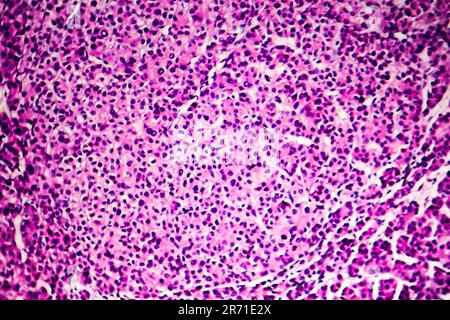 Hepatocellular Carcinoma Cancer Of Liver Light Micrograph Photo