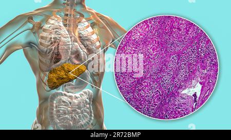 Liver Cirrhosis Computer Illustration And Light Micrograph Of A