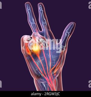 Dupuytren S Contracture Illustration Stock Photo Alamy