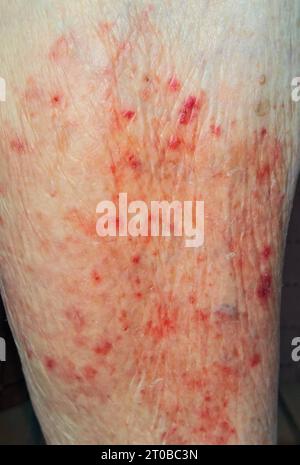 Gürtelrose Herpes Zoster Stock Photo Alamy