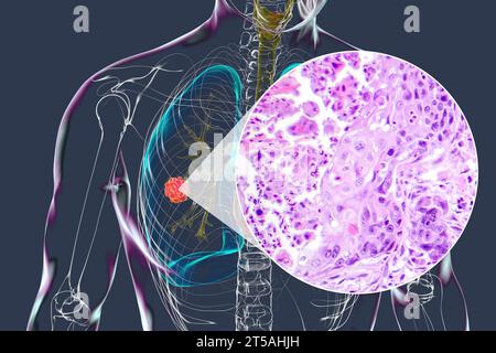 Lung Cancer Tumour And Light Micrograph Illustration Stock Photo Alamy