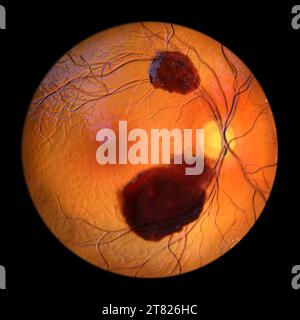 Subretinal Haemorrhage Illustration Stock Photo Alamy