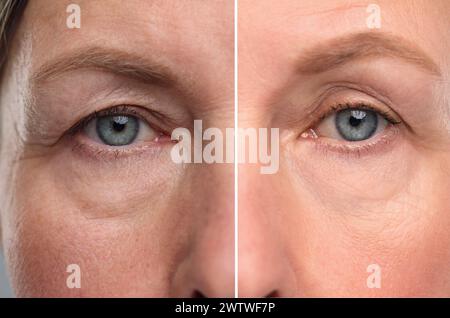 Aging Skin Changes Collage With Photos Of Mature Woman Before And