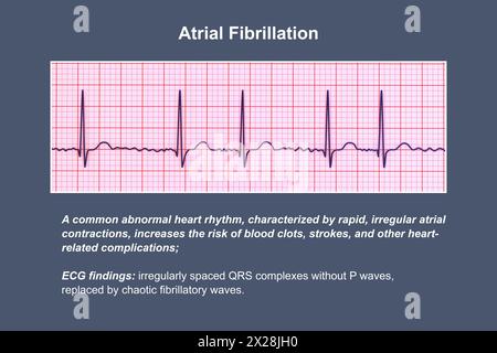 Ecg In Atrial Fibrillation Illustration Stock Photo Alamy