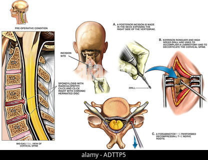 Spine Surgery Cervical Disc Protrusions At C And C With Stock Photo Alamy