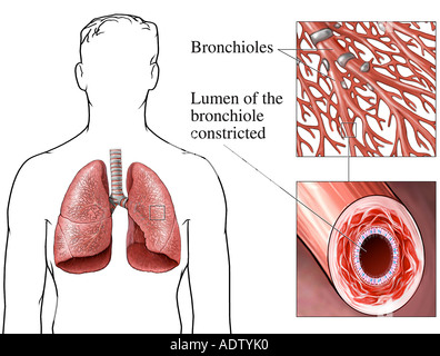 Shortness Of Breath Difficulty In Breathing Acute And Chronic Dyspnea