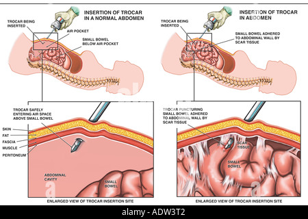 trocar insertion laparoscopic surgery aorta abdominal injury alamy laceration traumatic inappropriate iatrogenic small bowel