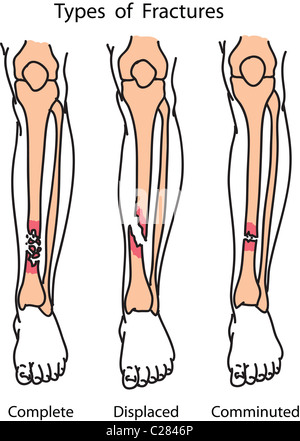 All Types Of Bone Fractures Stock Photo, Royalty Free Image: 80407308 ...