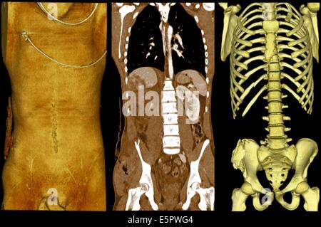 D Computed Tomographic Ct Reconstruction Scan Of The Pelvis Showing