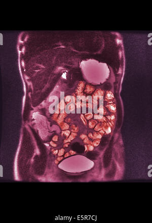 Colored Mri Magnetic Resonance Imaging Showing A Prostate Cancer