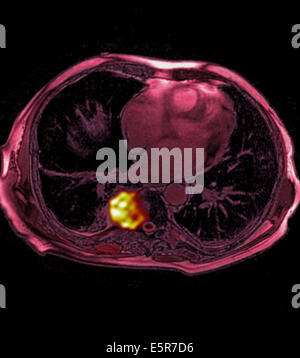 Colored Mri Magnetic Resonance Imaging Showing A Prostate Cancer Seen