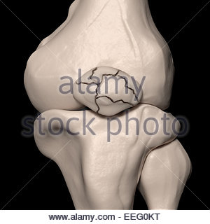 Digital medical illustration depicting a fracture of 11th rib Stock