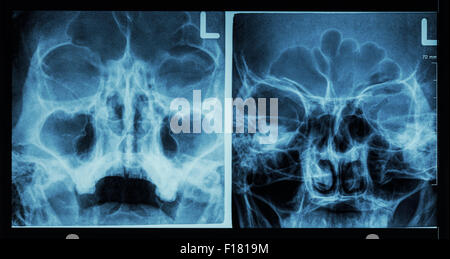 Xray Film Of A Skull Of A Patient Paranasal Sinus With Acute Right