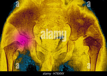 X Ray Congenital Dislocation Of Hips Stock Photo Alamy