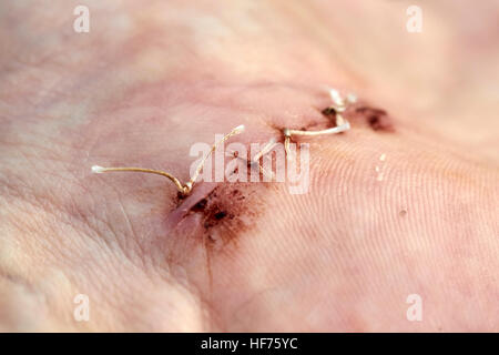 Dissolvable Stitches In A Hand Surgical Wound To Correct Carpal Tunnel