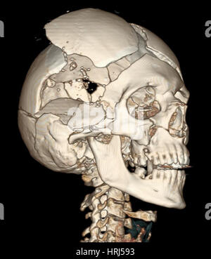 Three Dimensional Ct Scan Reconstruction Showing A Tripod Fracture