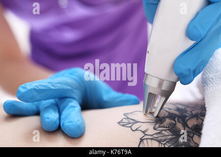 tattoo removal stock photo royalty free image 72477819 alamy tattoo removal stock photo royalty free image 72477819 alamy