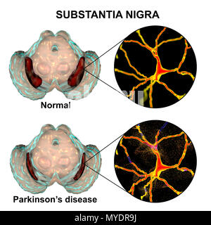 Illustration Showing Degeneration Of Dopaminergic Neurons In The Stock