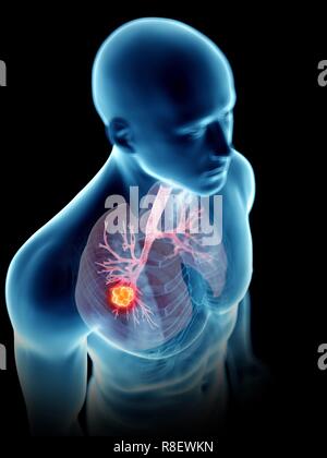 Illustration Of A Man S Lung Tumour Stock Photo Alamy