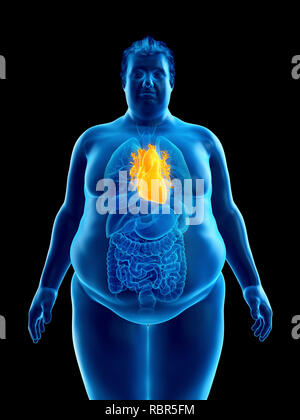 Illustration Of An Obese Man S Heart Stock Photo Alamy