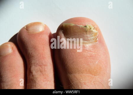 Fungal Nail Infection On The Big Toe Of The Foot Of An Adult Patient