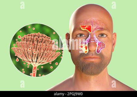 Pilze Als Ursache Einer Sinusitis Computerdarstellung Mit Entz Ndung