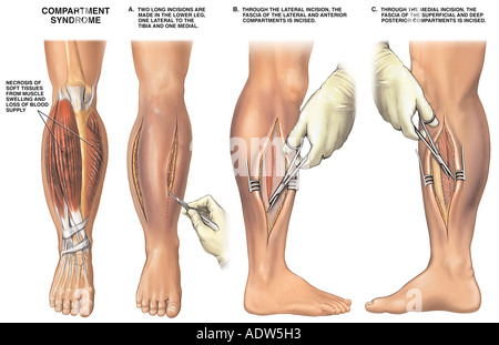 Ein Kompartmentsyndrom mit Fasziotomie Chirurgie Stockfoto, Bild